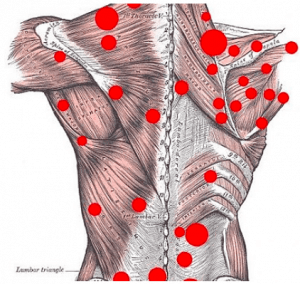 Trigger Point Injections - Waterville Maine - MaineCHI