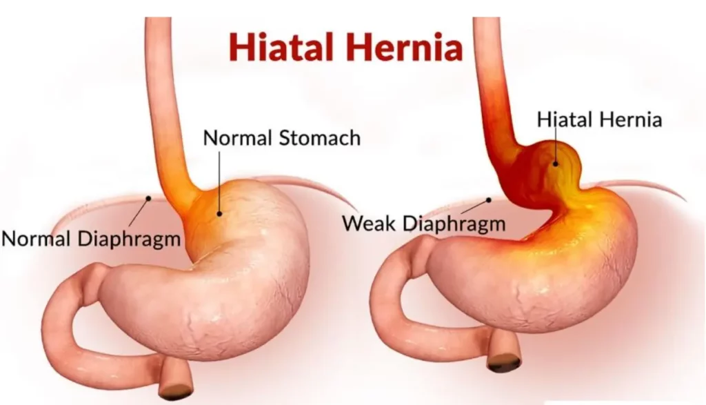 Understanding Gastric and Hiatal Hernias: How They Increase Reflux, Cause Chest Discomfort, and Affect Digestion 1