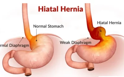 Understanding Gastric and Hiatal Hernias: How They Increase Reflux, Cause Chest Discomfort, and Affect Digestion